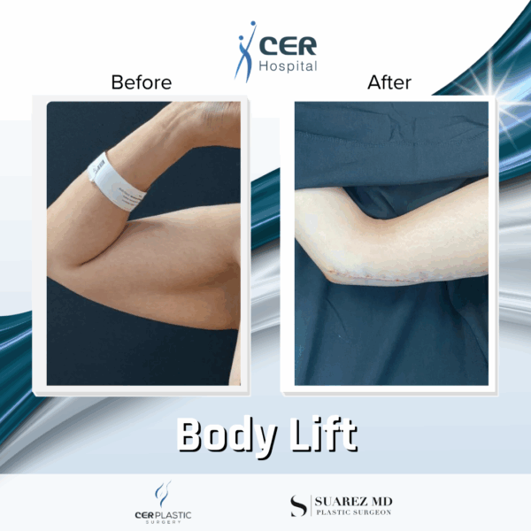 Body Lift - 201 - Image 9