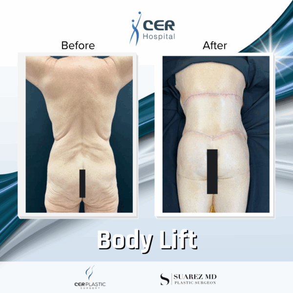 Body Lift - 081 - Image 9
