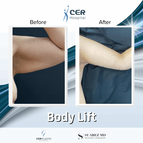 Body Lift - 201 - Image 10
