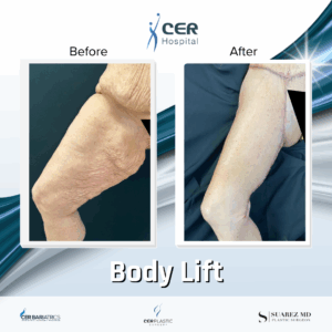 Body Lift – 291