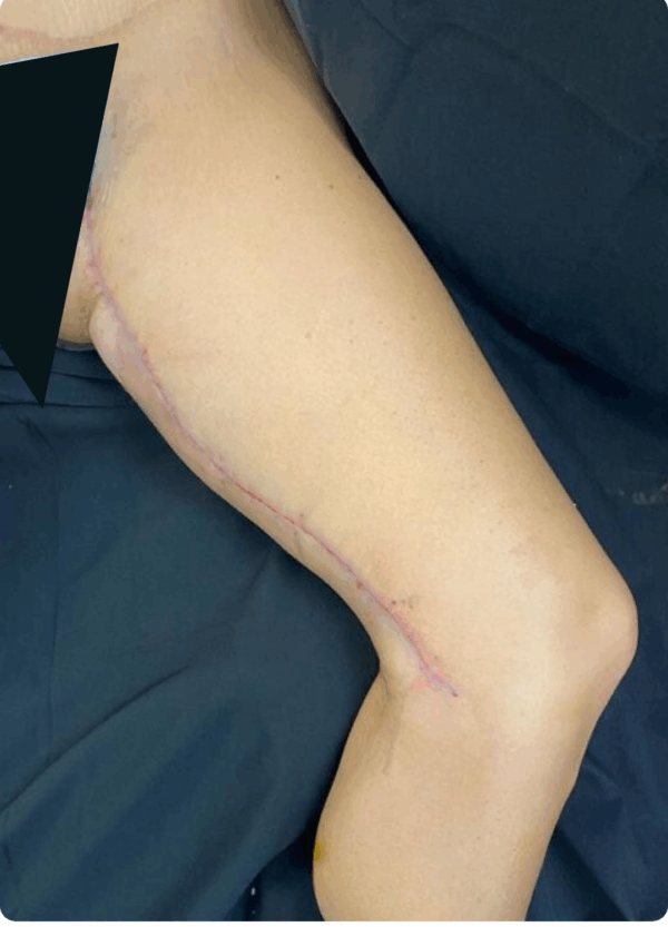 Mini Body Lift - 073 - Image 2