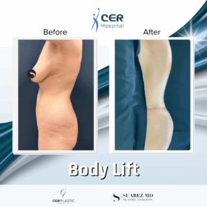 Body Lift – 125