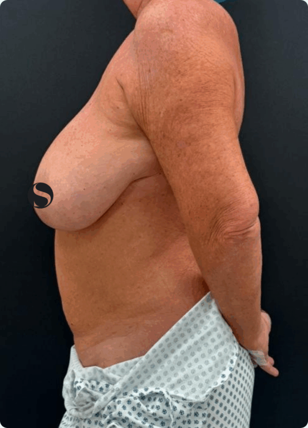Breast Reduction - 042 - Image 3