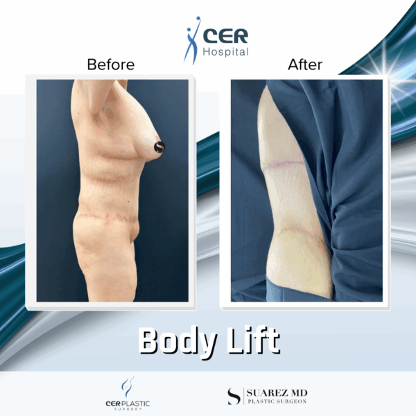 Body Lift - 201 - Image 11