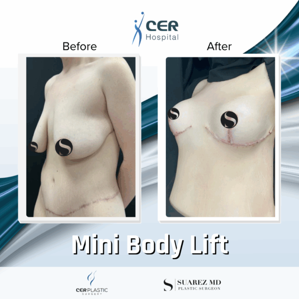 Body Lift - 094 - Image 4