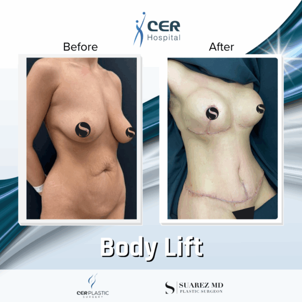 Body Lift - 125 - Image 4