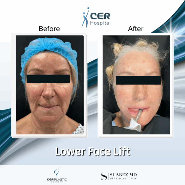 Lower Face Lift - 033 - Image 4