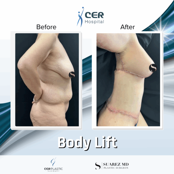 Body Lift - 165 - Image 4