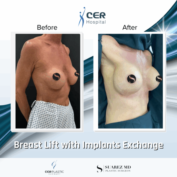 Breast Lift with Implants Exchange - 214 - Image 4
