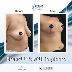 Breast Lift with Implants – 263