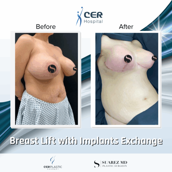 Breast Lift with Implants Exchange - 101 - Image 4