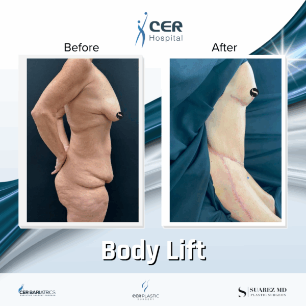 Body Lift - 291 - Image 4
