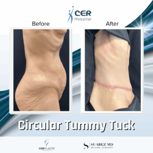 Circular Tummy Tuck – 056