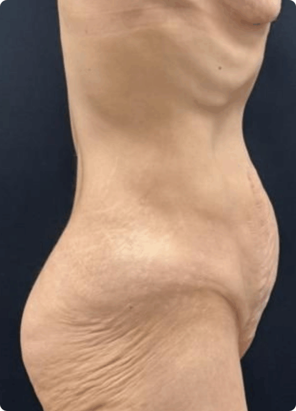 Circular Tummy Tuck - 056 - Image 3