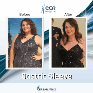 Gastric Sleeve