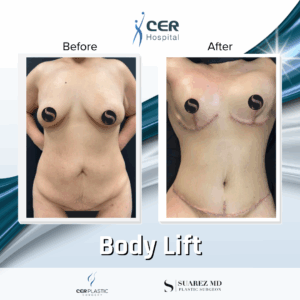 Body Lift – 213