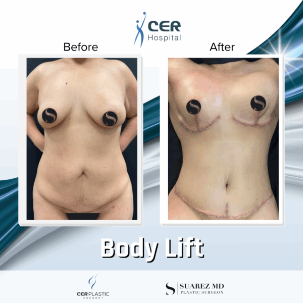 Body Lift - 213