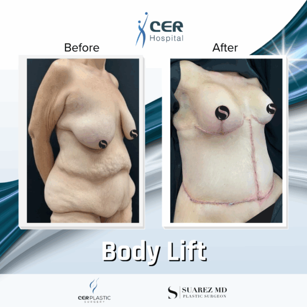 Body Lift - 075 - Image 4