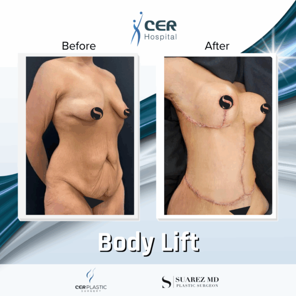 Body Lift - 304 - Image 4