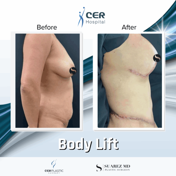 Body Lift - 234 - Image 4