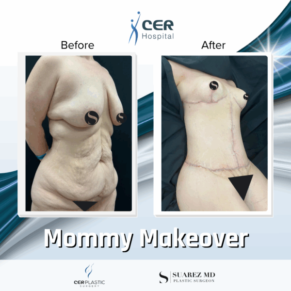 Mommy Makeover - 311 - Image 6