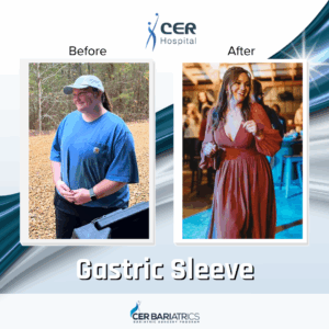Gastric Sleeve