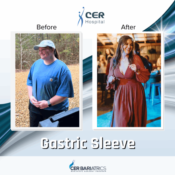 Gastric Sleeve