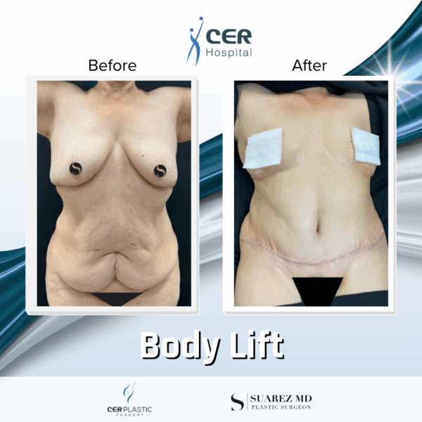 Body Lift - 144 - Image 4