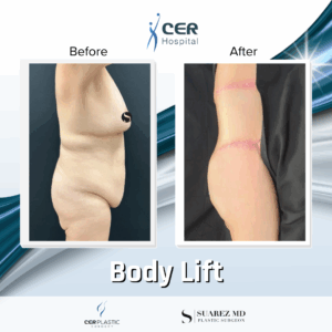 Body Lift – 037