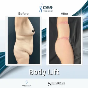 Body Lift – 037