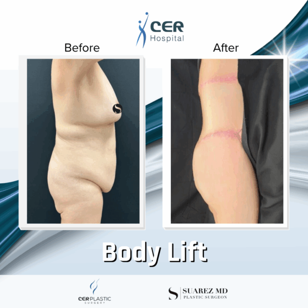 Body Lift - 037 - Image 2