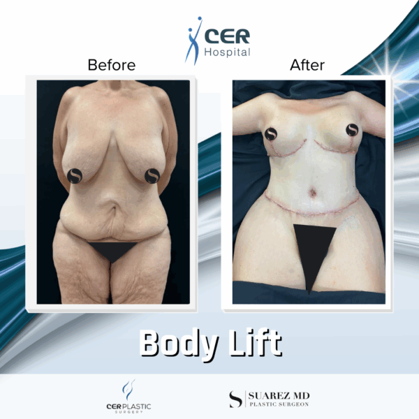 Body Lift -2094 - Image 4