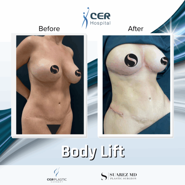 Body Lift -7104
