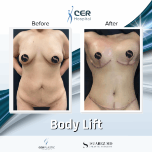 Body Lift – 213