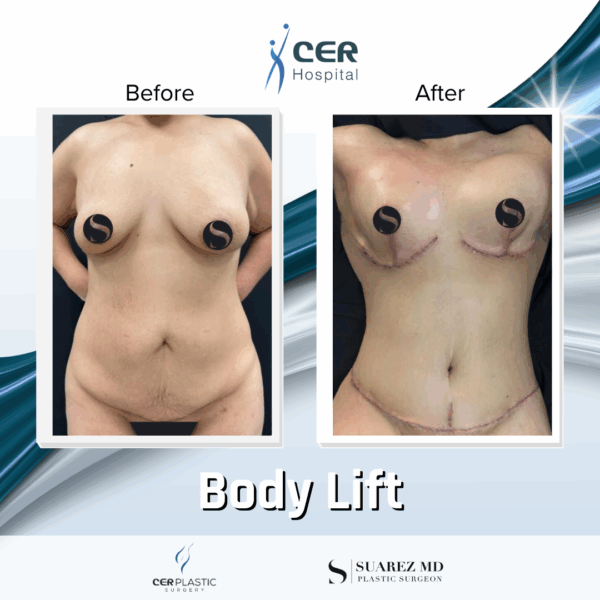 Body Lift - 213