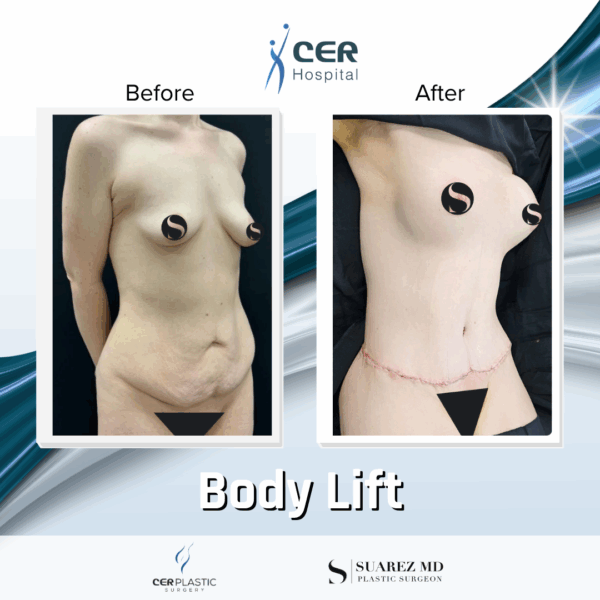 Body Lift - 19064 - Image 4
