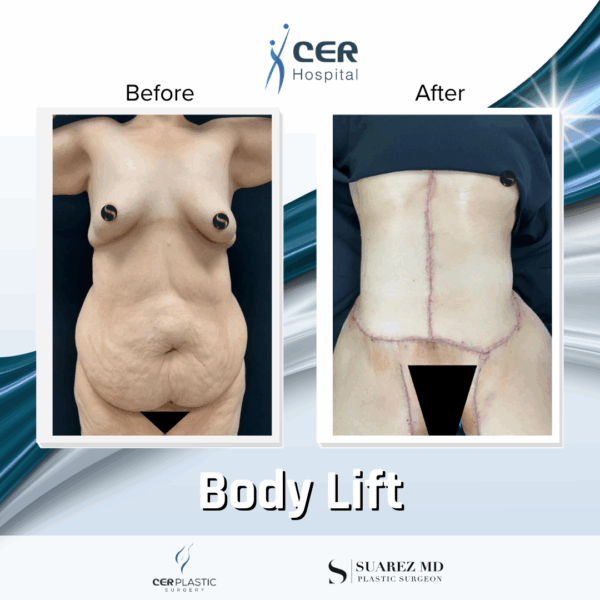 Body Lift - 17064 - Image 4