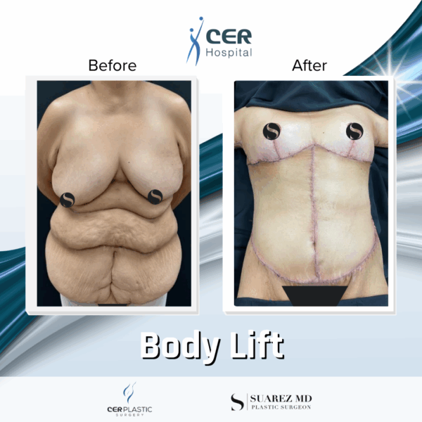Body Lift -14064 - Image 4