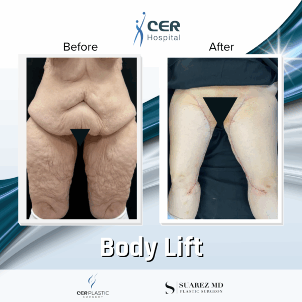 Mini Body Lift - 12064 - Image 4