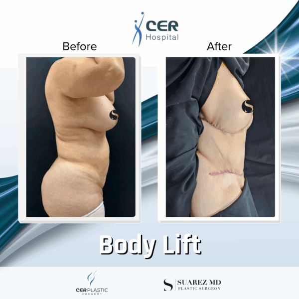 Body Lift and Eyelid Surgery - 5064 - Image 7
