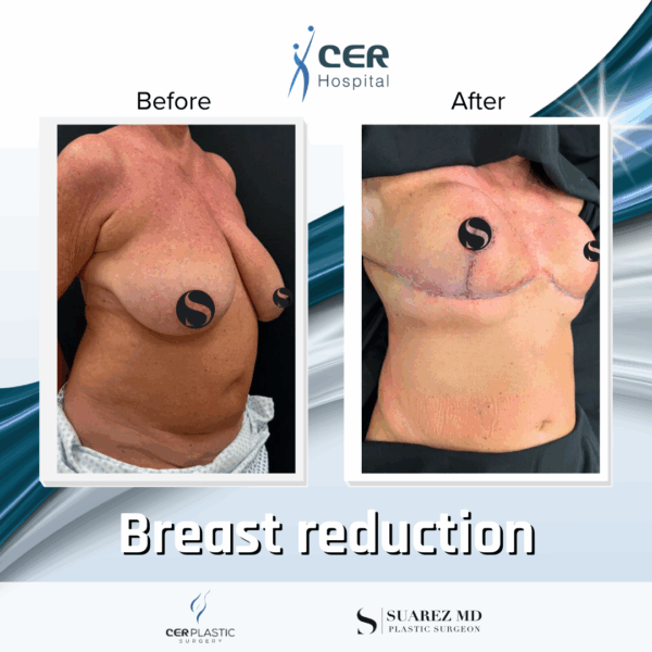 Breast Reduction - 042 - Image 4