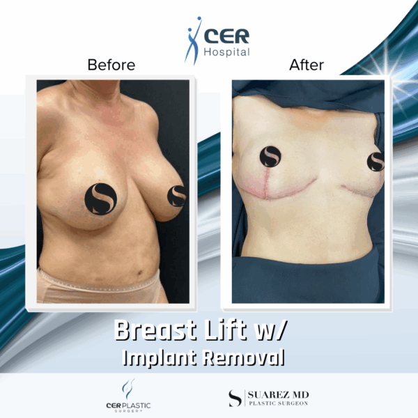 Breast Lift with Implant Removal - 5064 - Image 4