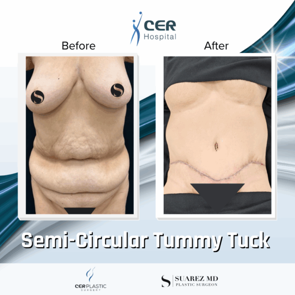 Semi Circular Tummy Tuck - 3064 - Image 4