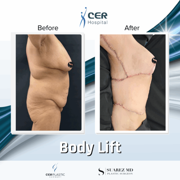 Body Lift - 20054 - Image 4