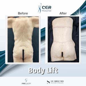 Body Lift – 17054