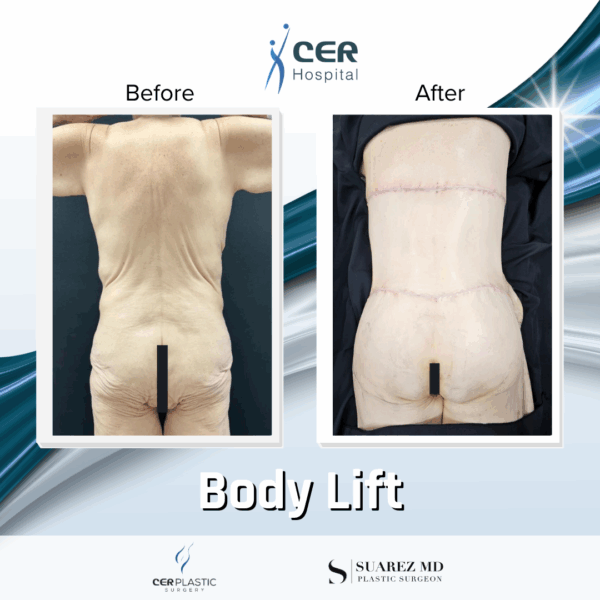 Body Lift - 17054