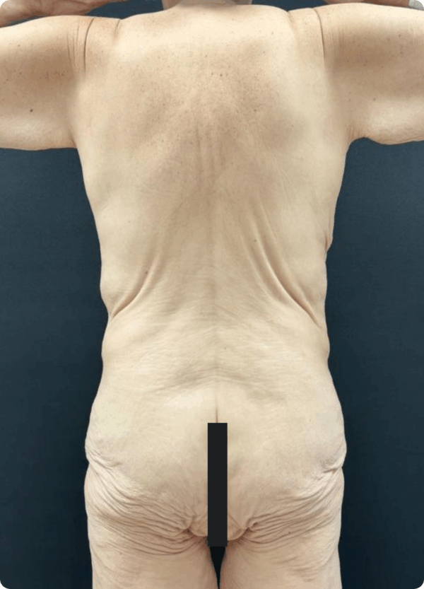 Body Lift - 17054 - Image 3