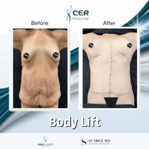 Body Lift – 8054