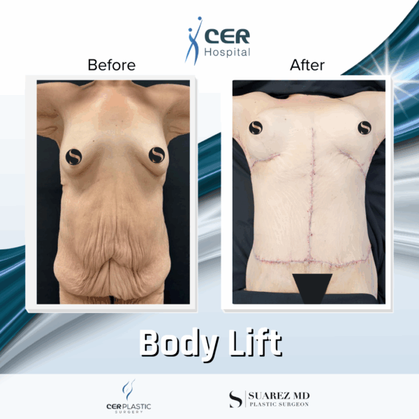 Body Lift - 8054
