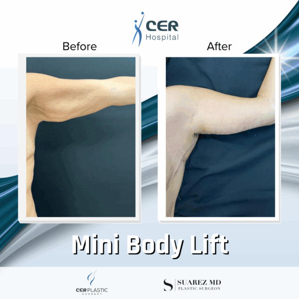 Mini Body Lift - 073 - Image 4